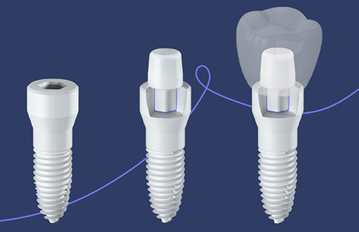 Implant Expertise