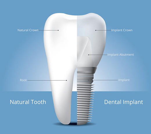 zirconia implant