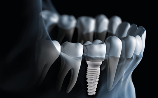 zirconia implant
